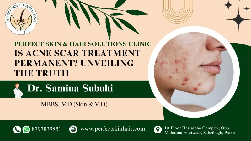 Is Acne Scar Treatment Permanent