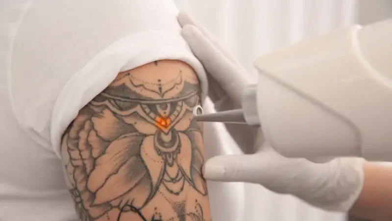 Tattoo removal in patna