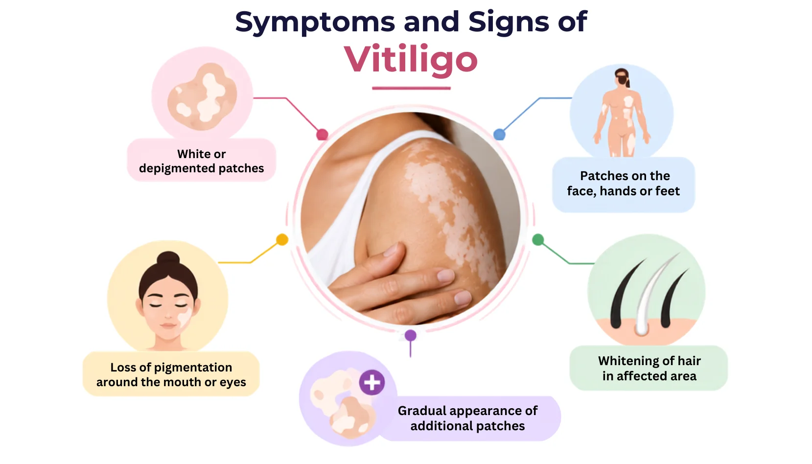 Symptoms and Signs of Vitiligo