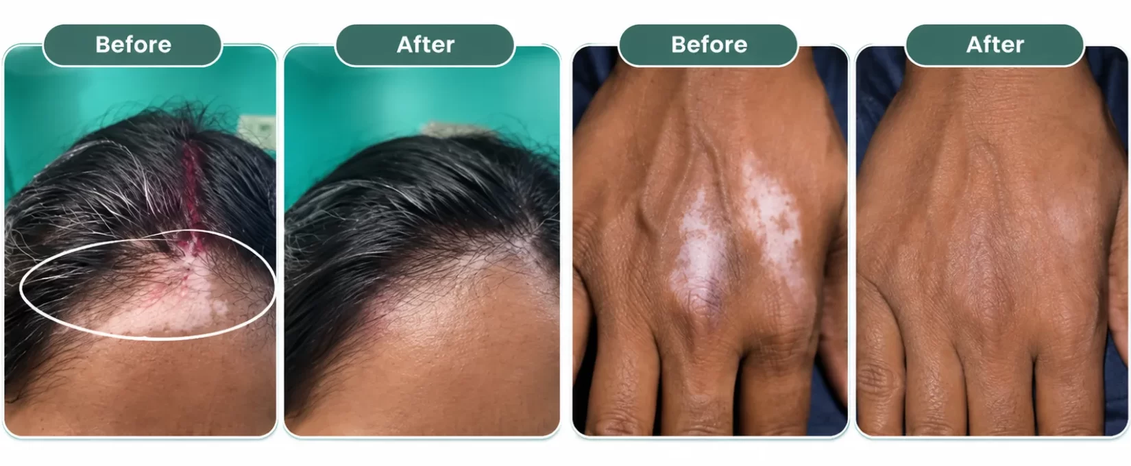 Vitiligo Treatment Results at Perfect Skin & Hair Solutions Clinic