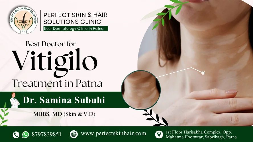 Best Doctor for Vitiligo Treatment in Patna