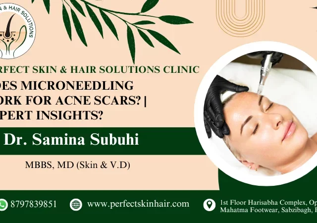 Microneedling for Acne Scars