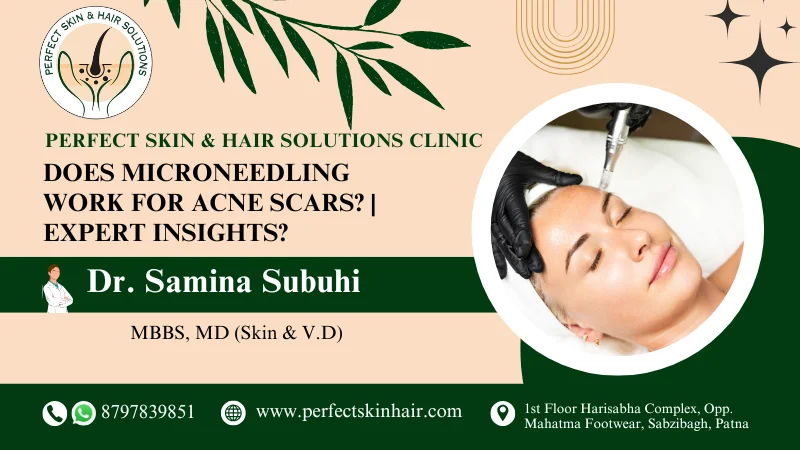 Microneedling for Acne Scars