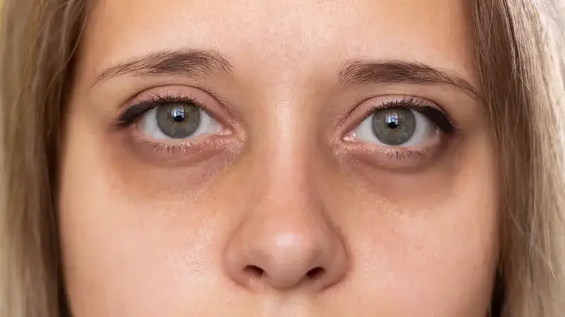 dark circles