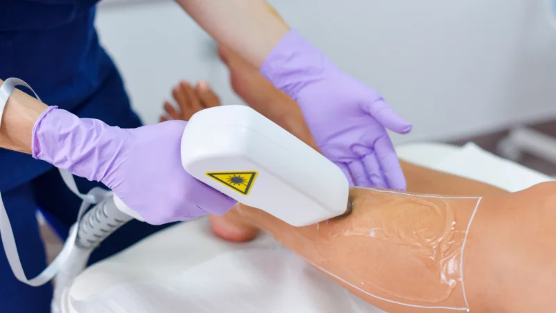 laser hair removal