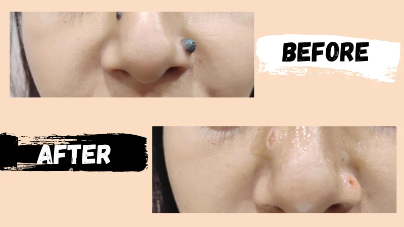 mole removal results