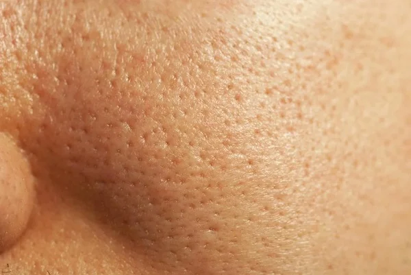 open-pores