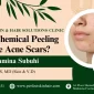 Does Chemical Peeling Remove Acne Scars