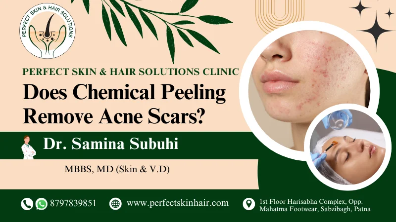 Does Chemical Peeling Remove Acne Scars