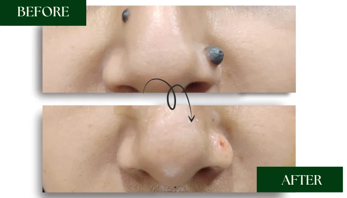 before after mole removal