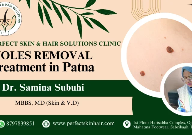 mole removal treatment in patna