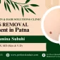 mole removal treatment in patna