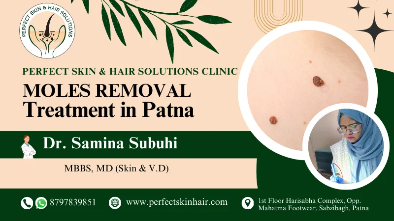 mole removal treatment in patna