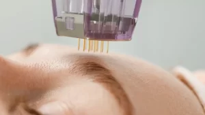 microneedling