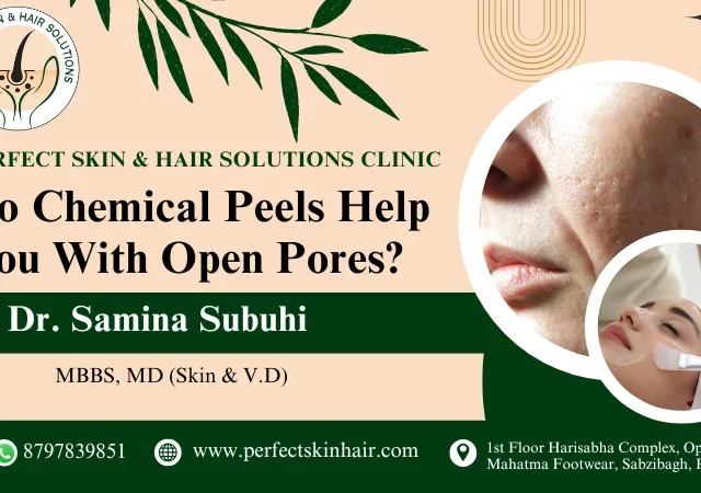 Chemical Peels for Open Pores