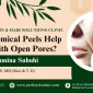 Chemical Peels for Open Pores
