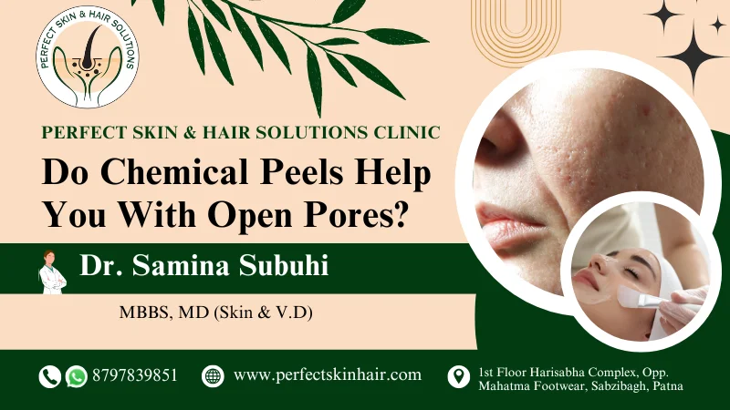 Chemical Peels for Open Pores
