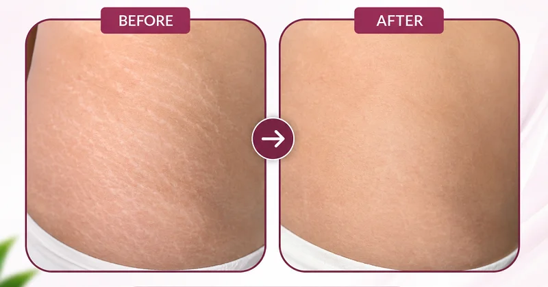 Before and After Results of Chemical Peel on Stretch Marks