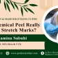 Can Chemical Peel Remove Stretch Marks