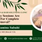 How many sessions are required for complete tattoo removal