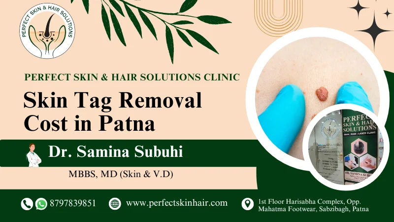 Skin Tag Removal Cost in Patna