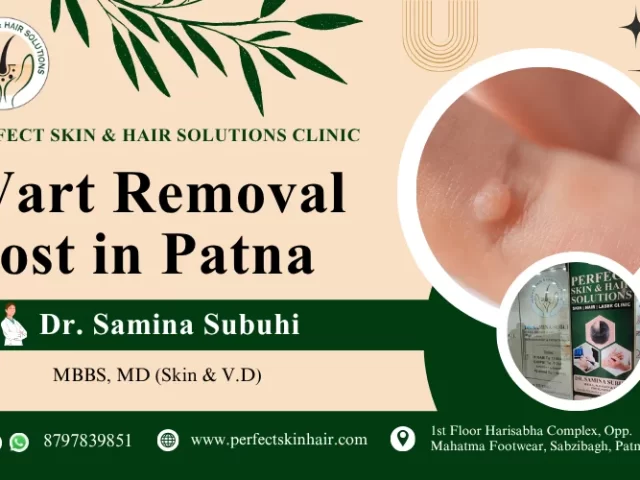 Wart Removal Cost in Patna