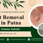 Wart Removal Cost in Patna