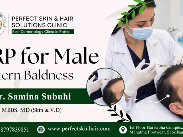 PRP for male pattern baldness