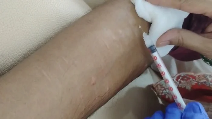 Scar Removal Treatments