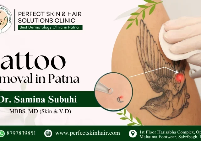 tattoo removal patna