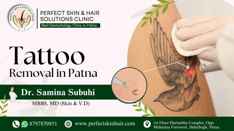 tattoo removal patna