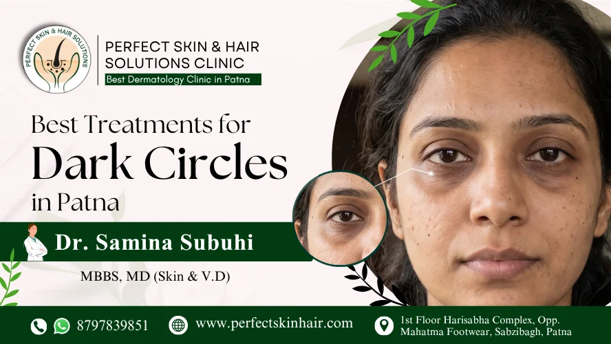 Best Treatments for Dark Circles in Patna